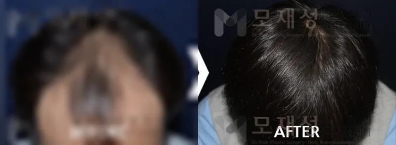 남성탈모 2,620모낭 수술 후 12개월 경과 가려진 수술 전 사진과 수술 후 사진