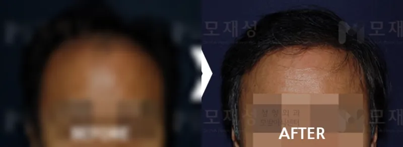 男性の薄毛2650毛包単位 術後12か月経過 ぼかした術前写真と術後写真