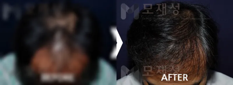 남성탈모 2,650모낭 수술 후 12개월 경과 가려진 수술 전 사진과 수술 후 사진