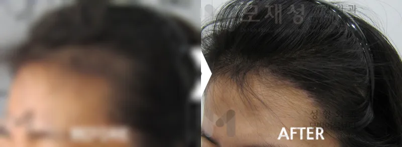 여성헤어라인교정 수술전후 가려진 수술 전 사진과 수술 후 사진