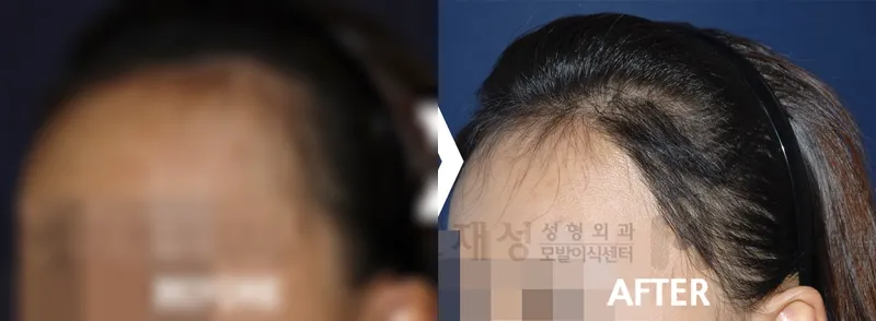여성헤어라인 1,210모낭 수술후 12개월 가려진 수술 전 사진과 수술 후 사진