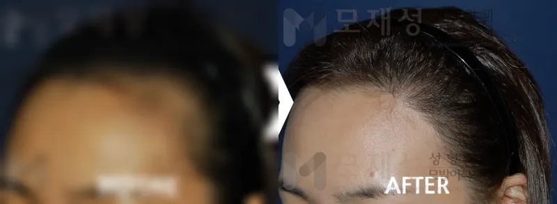 여성헤어라인 1,250모낭 수술후 12개월 가려진 수술 전 사진과 수술 후 사진