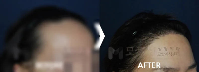 여성헤어라인 1,420모낭 수술후 12개월 가려진 수술 전 사진과 수술 후 사진
