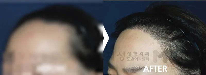 여성헤어라인 1,420모낭 수술후 12개월 가려진 수술 전 사진과 수술 후 사진