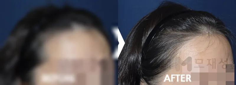 여성헤어라인 1,030모낭 수술후 12개월 가려진 수술 전 사진과 수술 후 사진