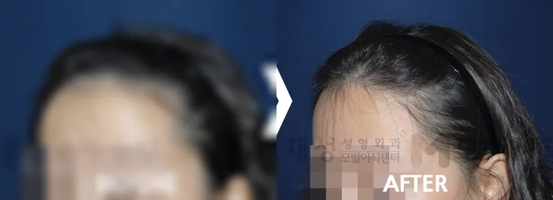 女性の生え際1160毛包単位 術後12か月 ぼかした術前写真と術後写真