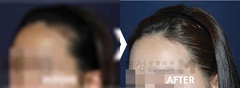 女性の生え際1160毛包単位 術後12か月 ぼかした術前写真と術後写真