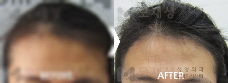 여성헤어라인 수술전후 가려진 수술 전 사진과 수술 후 사진