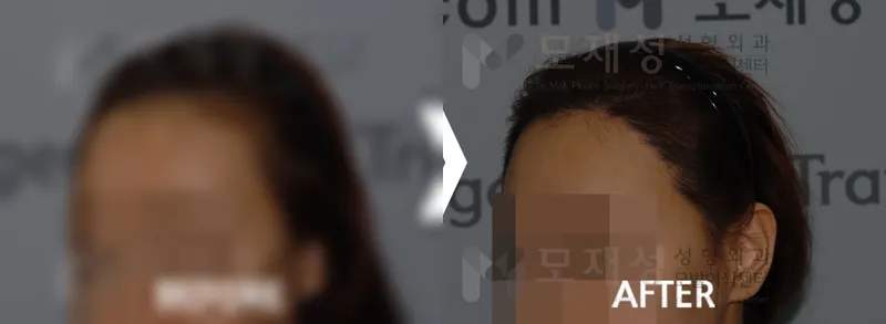 여성 헤어라인 1,366모낭 수술전후 사진 가려진 수술 전 사진과 수술 후 사진