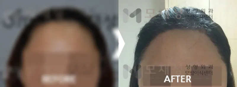 女性の生え際修正1733毛包単位の術前・術後写真です ぼかした術前写真と術後写真