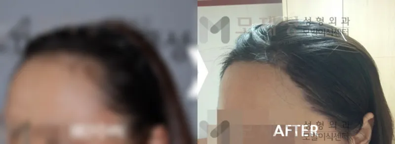 女性の生え際修正1733毛包単位の術前・術後写真です ぼかした術前写真と術後写真