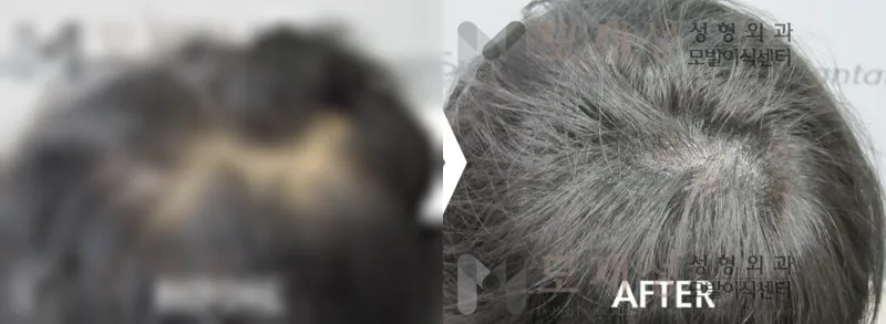 두피색소요법 시술 전후 가려진 수술 전 사진과 수술 후 사진