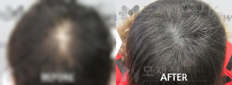 두피색소요법 시술전후 가려진 수술 전 사진과 수술 후 사진