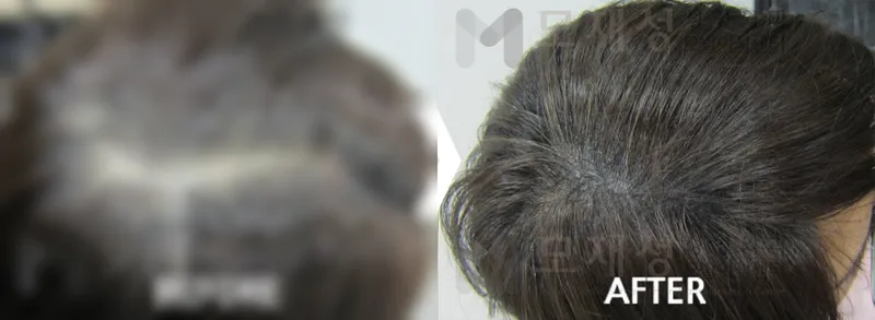두피색소요법 시술전후 가려진 수술 전 사진과 수술 후 사진