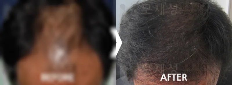 남성탈모 2,950모낭 수술 후 12개월 경과 가려진 수술 전 사진과 수술 후 사진