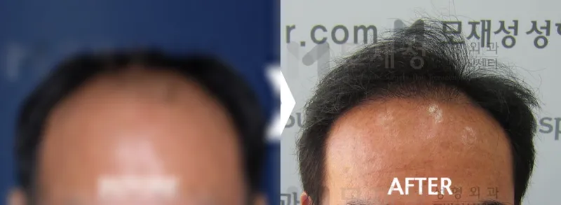 남성탈모 2,950모낭 수술 후 12개월 경과 가려진 수술 전 사진과 수술 후 사진