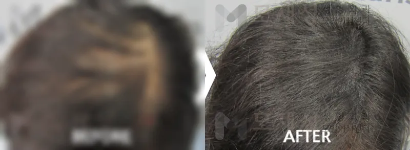 頭皮色素療法の施術前後 ぼかした術前写真と術後写真
