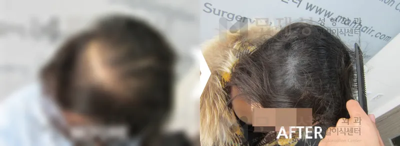 두피색소요법 시술전후 가려진 수술 전 사진과 수술 후 사진