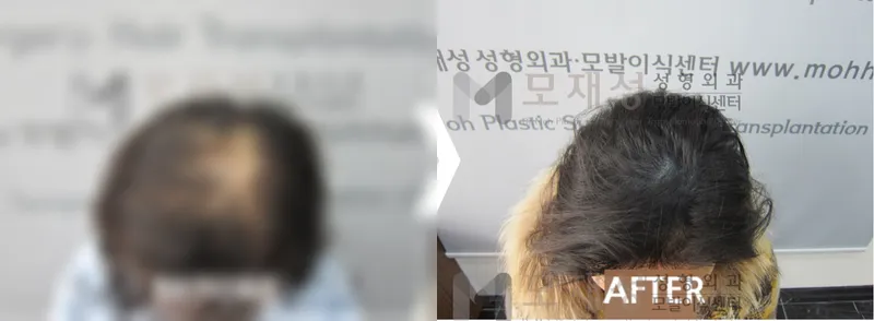 두피색소요법 시술전후 가려진 수술 전 사진과 수술 후 사진