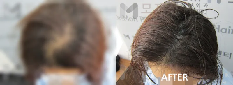 두피색소요법 시술전후 가려진 수술 전 사진과 수술 후 사진