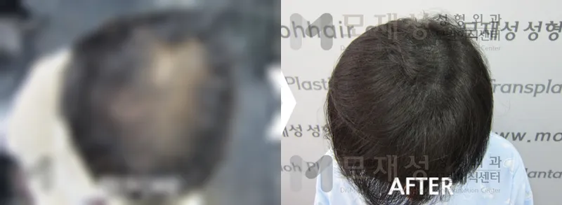 두피색소요법 시술전후 가려진 수술 전 사진과 수술 후 사진