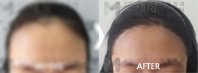 여성헤어라인 수술전후 가려진 수술 전 사진과 수술 후 사진