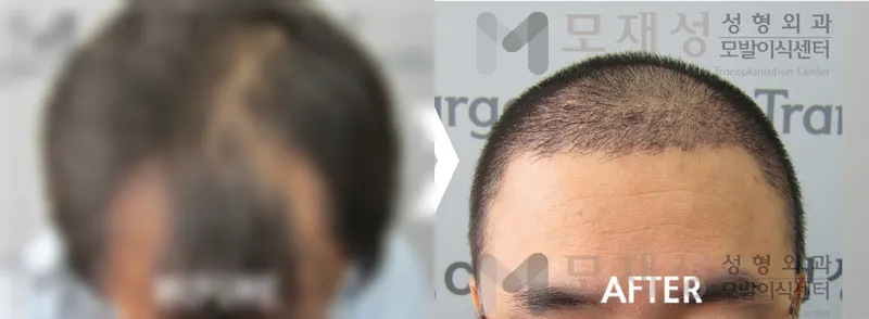 2,544모낭 수술전후 가려진 수술 전 사진과 수술 후 사진