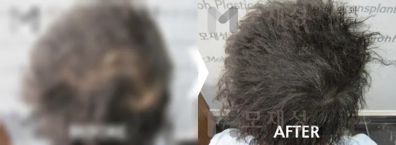 두피색소요법 시술전후 가려진 수술 전 사진과 수술 후 사진