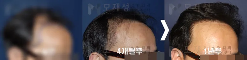 3,644모낭(7,200모) 수술 전후 가려진 수술 전 사진과 수술 후 사진