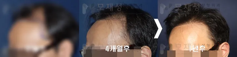 3,644모낭(7,200모) 수술 전후 가려진 수술 전 사진과 수술 후 사진