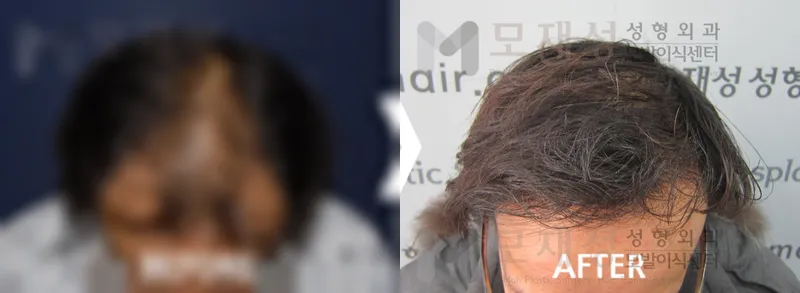 3,644모낭(7,200모) 수술 전후 가려진 수술 전 사진과 수술 후 사진
