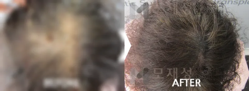 두피색소요법 시술전후 가려진 수술 전 사진과 수술 후 사진