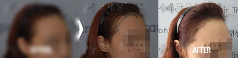 여성헤어라인 수술전후 가려진 수술 전 사진과 수술 후 사진
