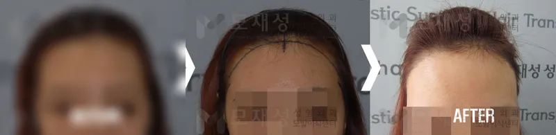 여성헤어라인 수술전후 가려진 수술 전 사진과 수술 후 사진
