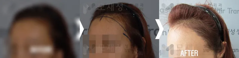 여성헤어라인 수술전후 가려진 수술 전 사진과 수술 후 사진