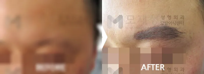 男性の眉毛移植 術前・術後写真 ぼかした術前写真と術後写真