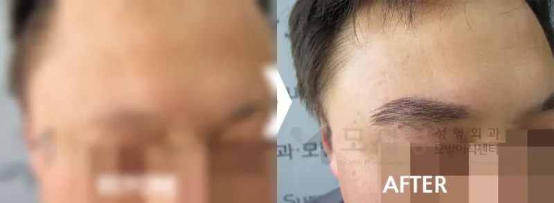 男性の眉毛移植 術前・術後写真 ぼかした術前写真と術後写真