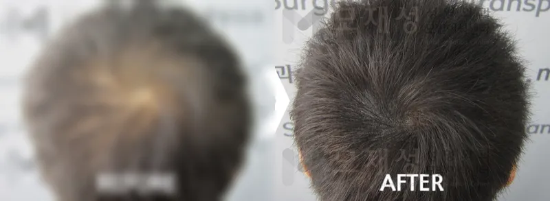 두피색소요법 시술전후 가려진 수술 전 사진과 수술 후 사진