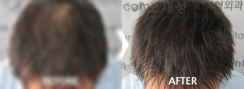 두피색소요법 시술전후 가려진 수술 전 사진과 수술 후 사진