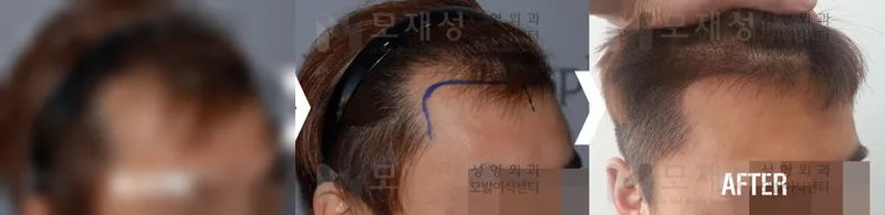 1,300모낭(2,800모) 수술 전후 가려진 수술 전 사진과 수술 후 사진