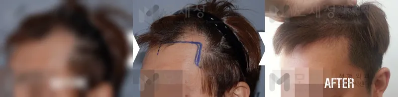 1,300 follicular units (2,800 hairs): before and after surgery A blurred before photo and the after photo