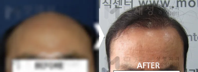 3,900모낭(7,800모) 수술 전후 가려진 수술 전 사진과 수술 후 사진