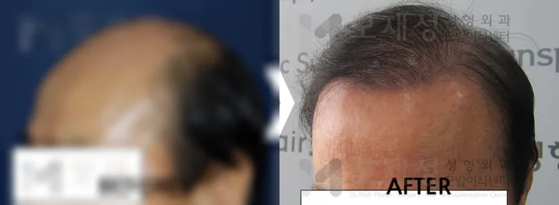 3,900모낭(7,800모) 수술 전후 가려진 수술 전 사진과 수술 후 사진
