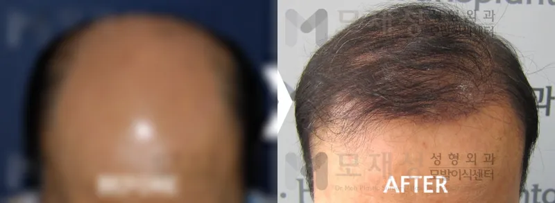 3,900모낭(7,800모) 수술 전후 가려진 수술 전 사진과 수술 후 사진