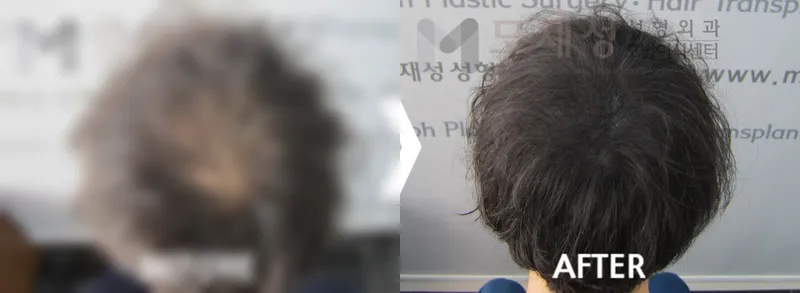 두피색소요법 시술전후 가려진 수술 전 사진과 수술 후 사진