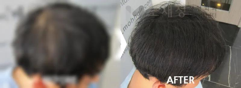두피색소요법 시술전후 가려진 수술 전 사진과 수술 후 사진