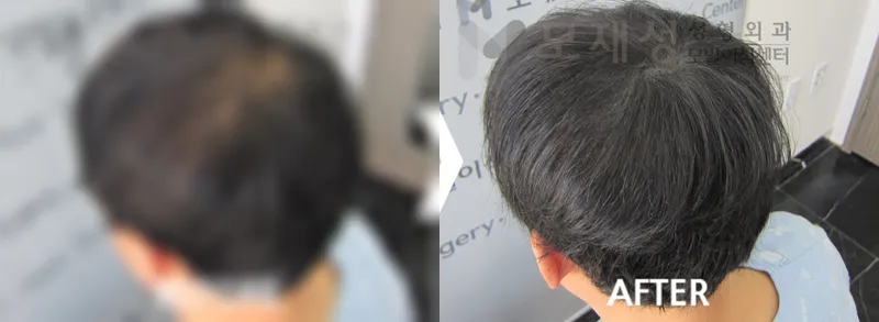두피색소요법 시술전후 가려진 수술 전 사진과 수술 후 사진