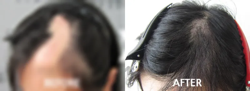 두피 흉터 모발 이식 수술 전후 사진 가려진 수술 전 사진과 수술 후 사진