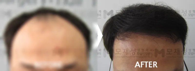 비절개 3,600모낭 수술전후 사진 가려진 수술 전 사진과 수술 후 사진