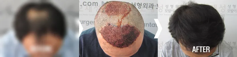 비절개 3,600모낭 수술전후 사진 가려진 수술 전 사진과 수술 후 사진